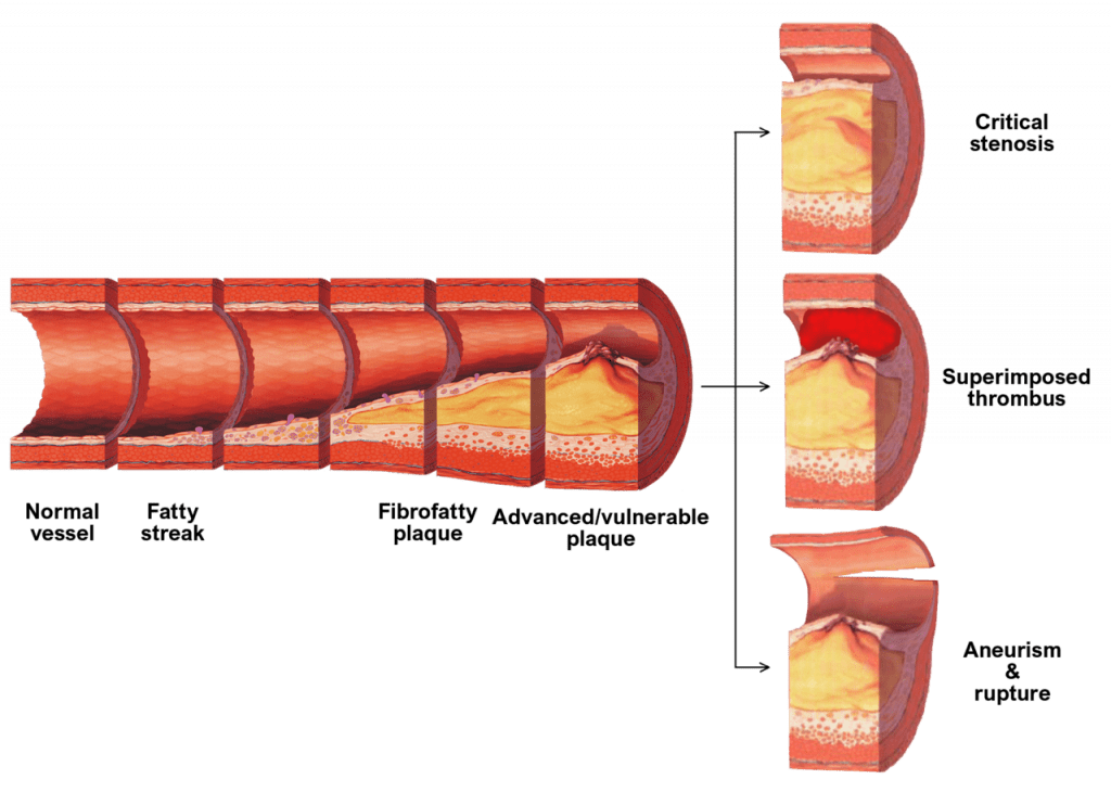 atherosclerotic plaque